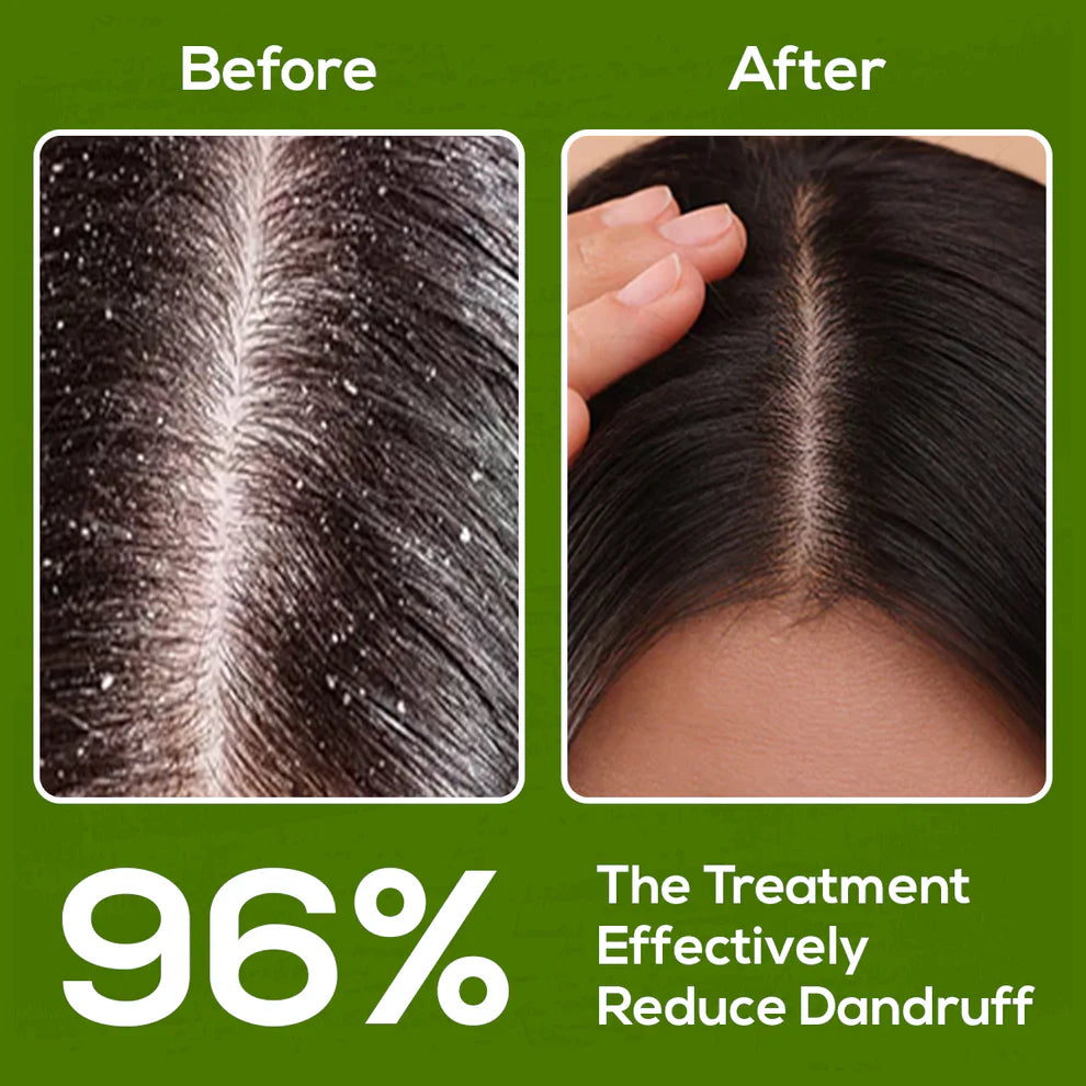 Before And After Atoz Naturals Anti-Dandruff Serum